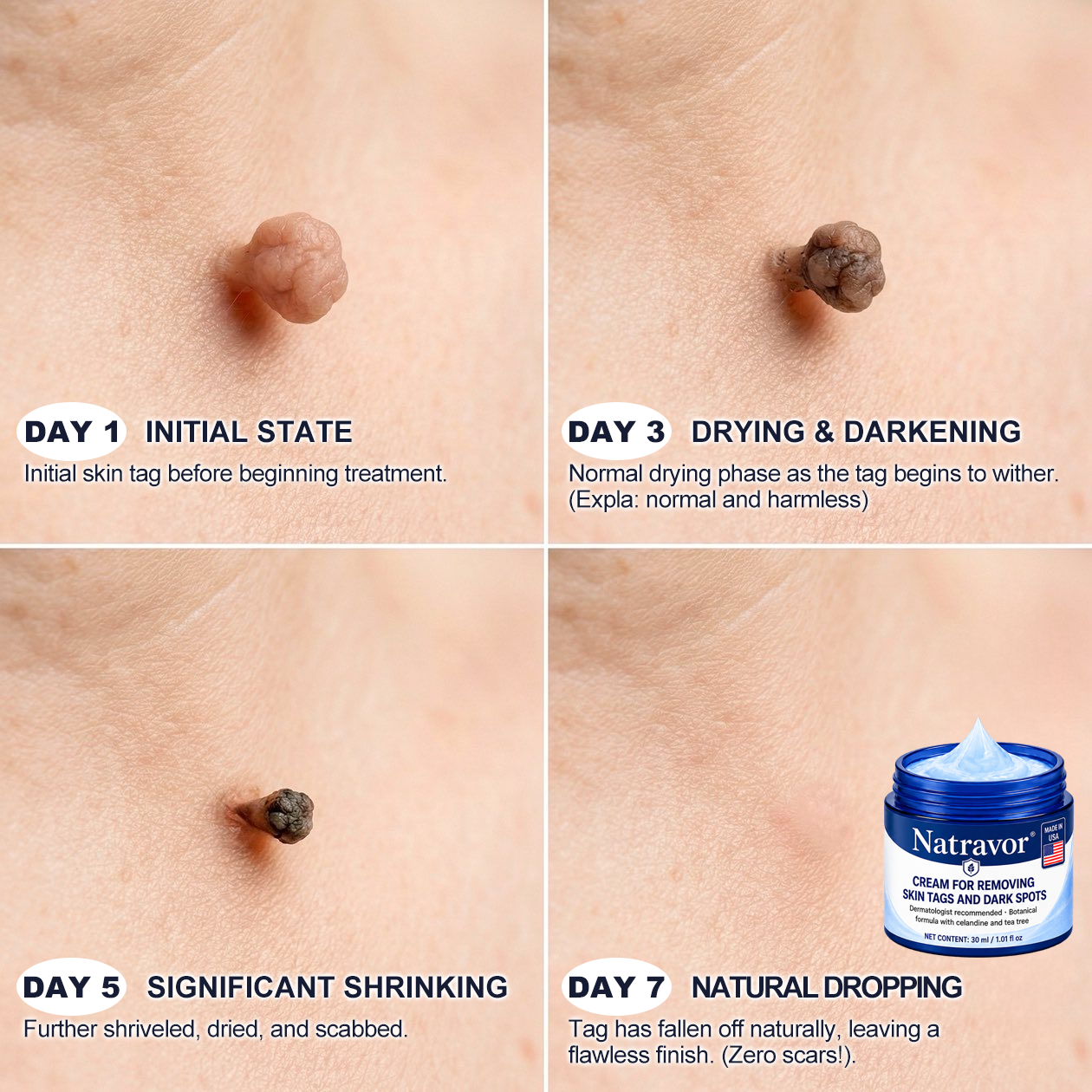 Natravor® 7-𝐃𝐚𝐲 𝐒𝐤𝐢𝐧 𝐓𝐚𝐠 & 𝐒𝐩𝐨𝐭 𝐄𝐫𝐚𝐬𝐞𝐫 𝐂𝐫𝐞𝐚𝐦 (Zero Pain, Zero 𝐒𝐜𝐚𝐫𝐬 Formula) 💎e