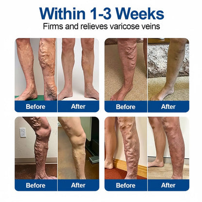 🏆🇺🇸👨‍⚕️✅Natravor®  VeinEase Microneedle Care Patch⚡Instant Relief, Long-Term Results