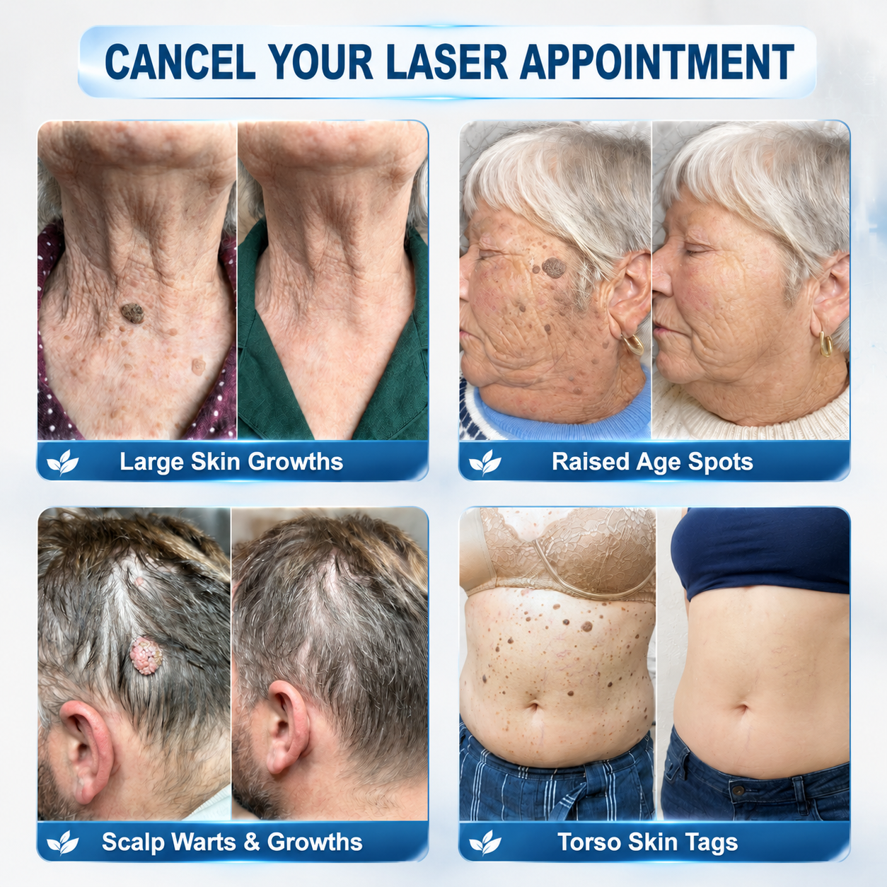 🎁 Only 5 boxes left! Get an extra 50% OFF today! Remove unwanted skin tags and enjoy smoother, clearer skin. Miss this offer, and you won't have another chance until next year!