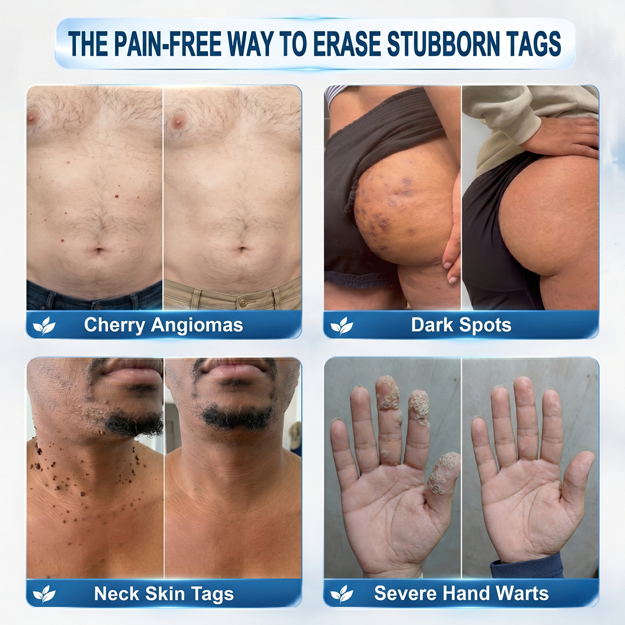 Natravor® 7-𝐃𝐚𝐲 𝐒𝐤𝐢𝐧 𝐓𝐚𝐠 & 𝐒𝐩𝐨𝐭 𝐄𝐫𝐚𝐬𝐞𝐫 𝐂𝐫𝐞𝐚𝐦 (Zero Pain, Zero 𝐒𝐜𝐚𝐫𝐬 Formula) 💎a